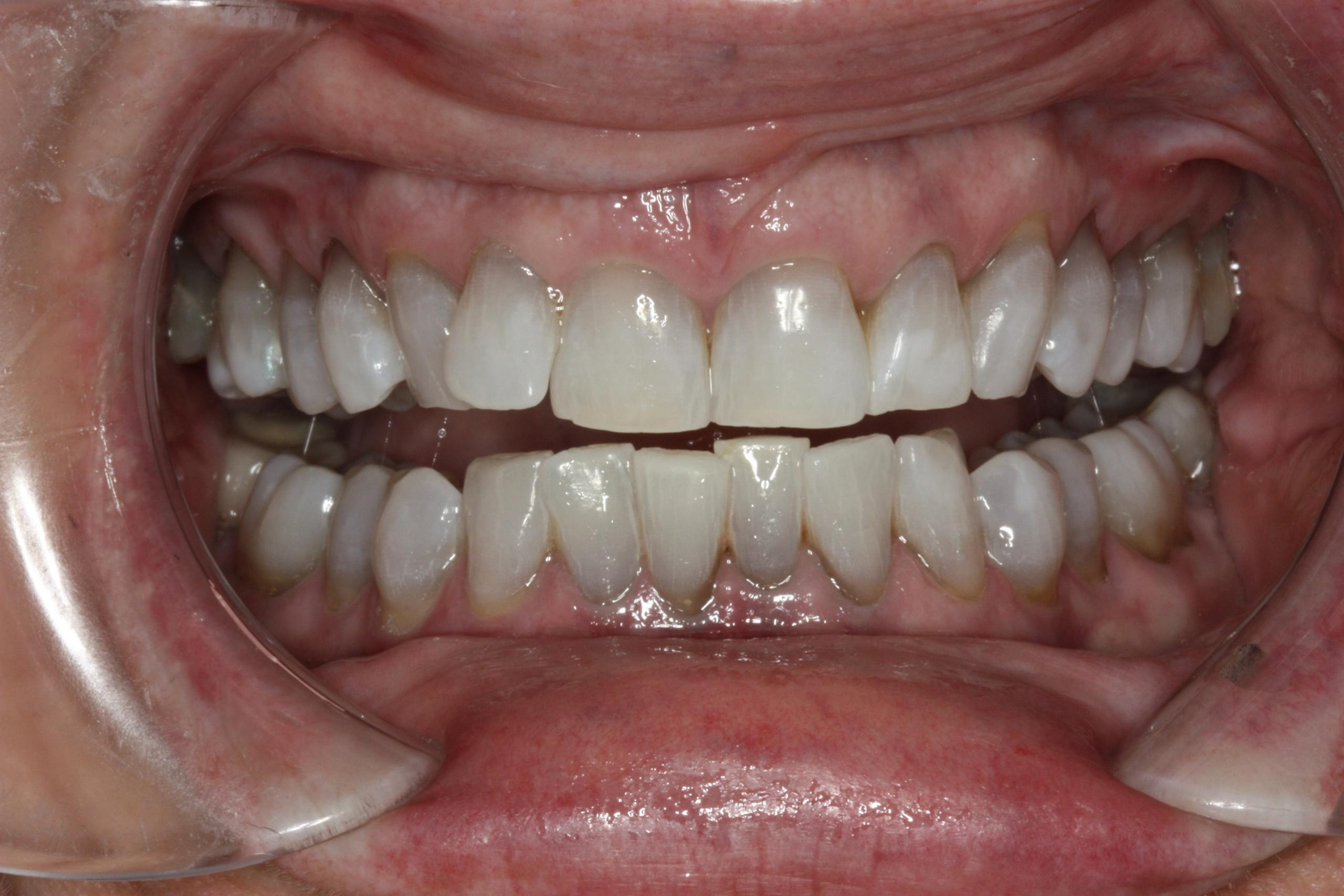 After tetracycline staining treatment
