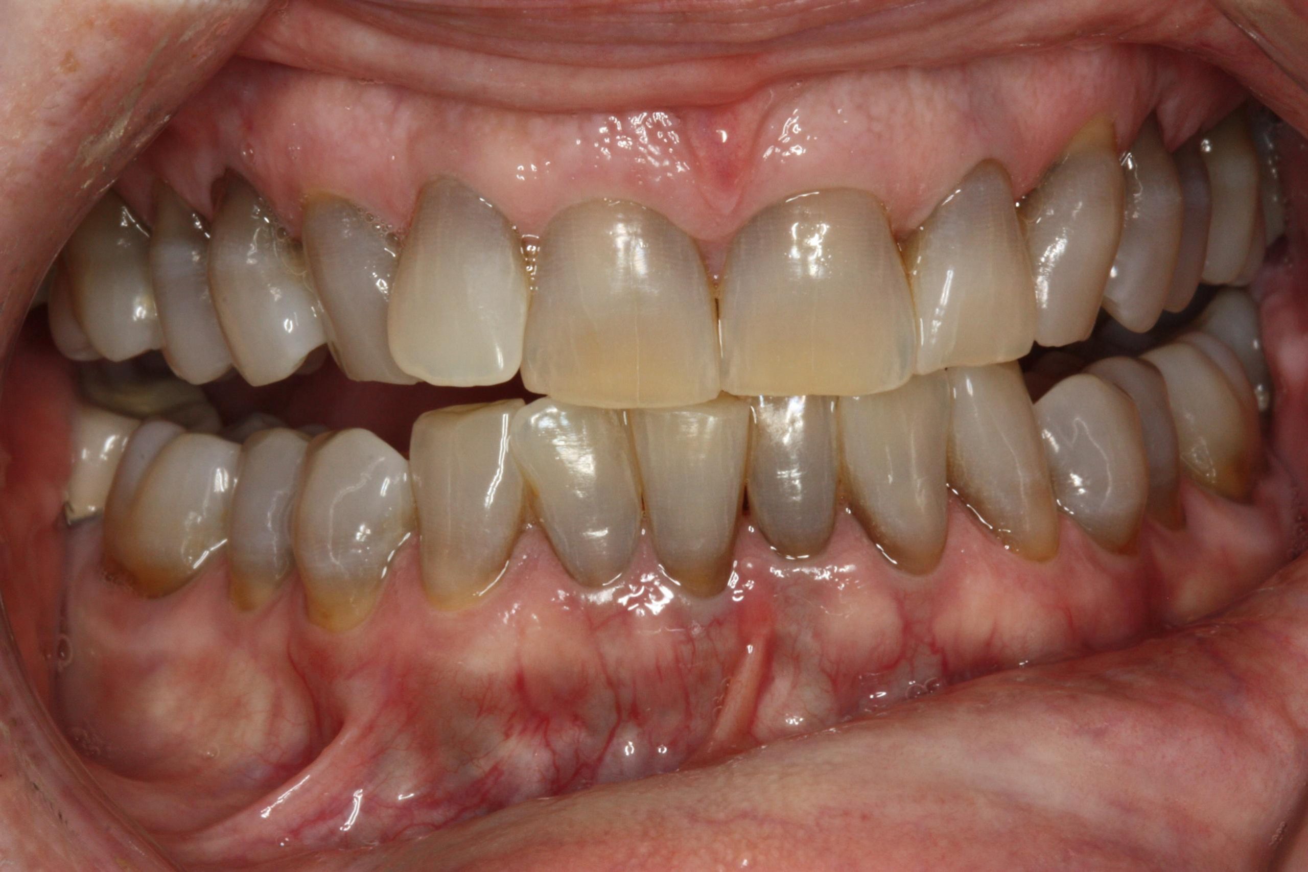 Before tetracycline staining treatment